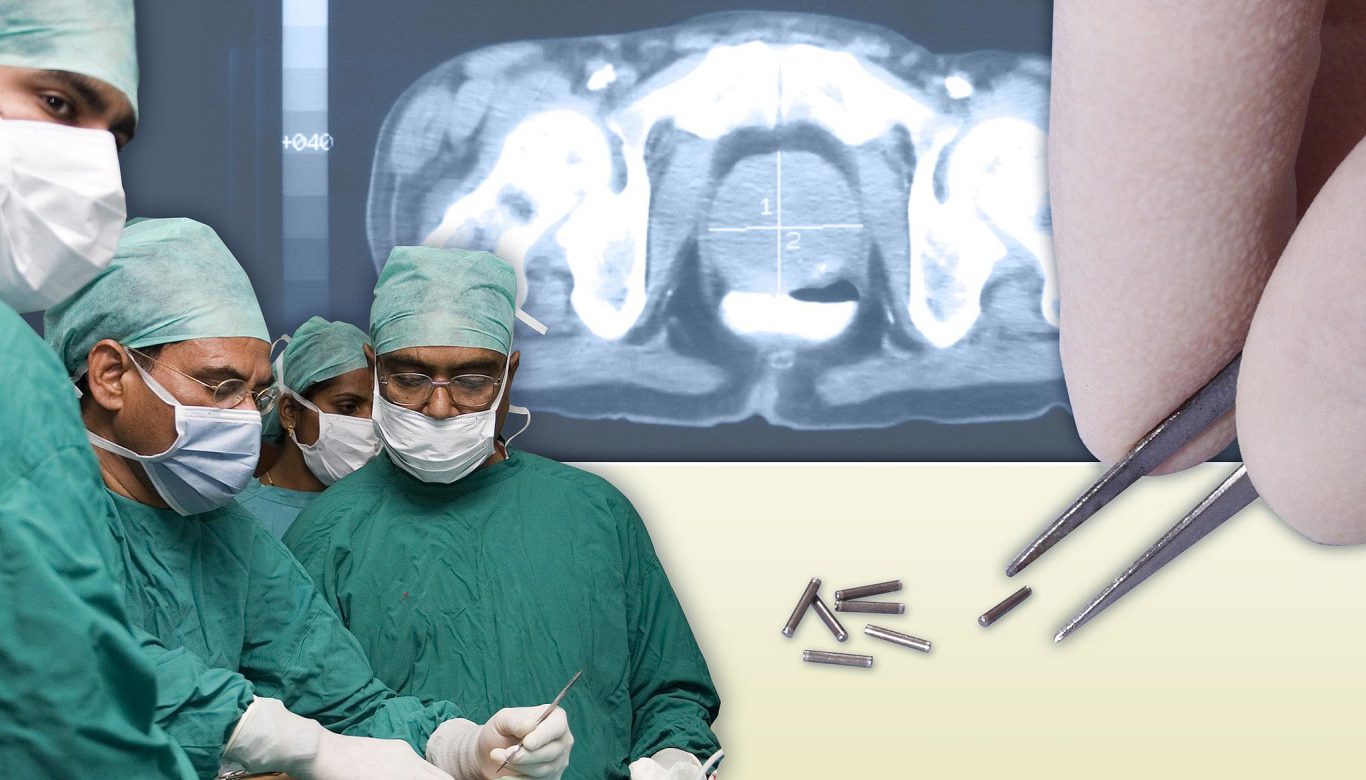 Using radiationemitting capsules to treat cervical cancer